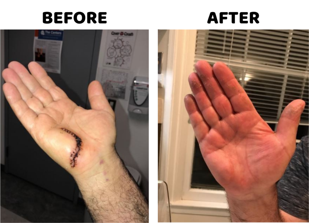 Customers Review Before And After for Advanced Scar Gel