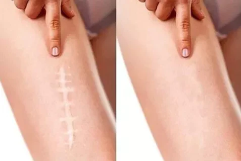 advanced scar gel review