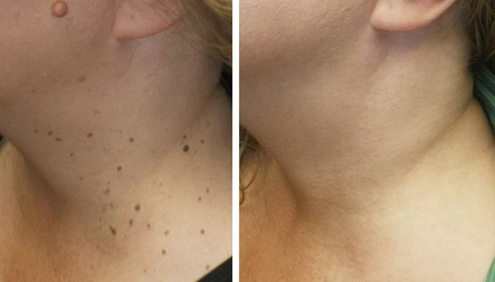 callista review on exfoliating gel